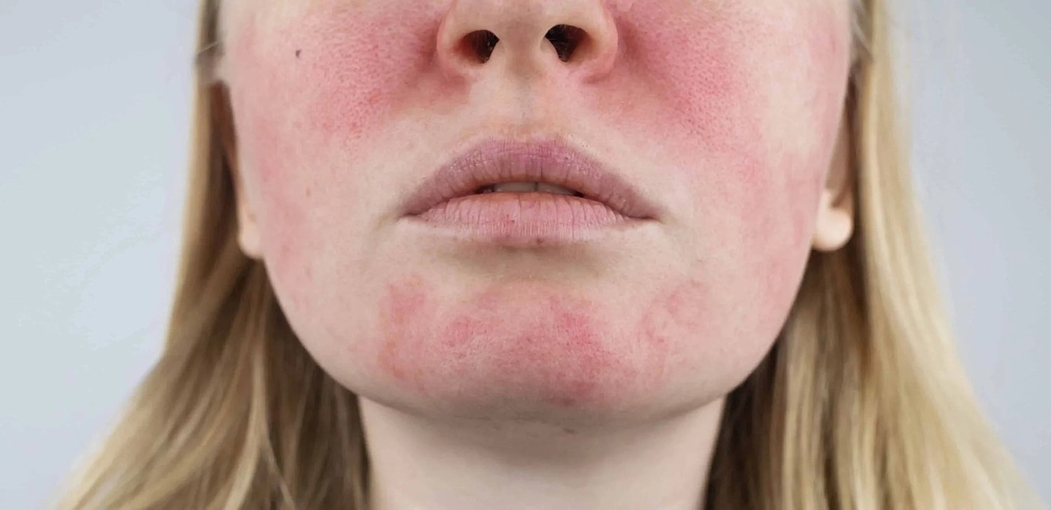 Understanding Rosacea: Symptoms, Treatment Option & Triggers