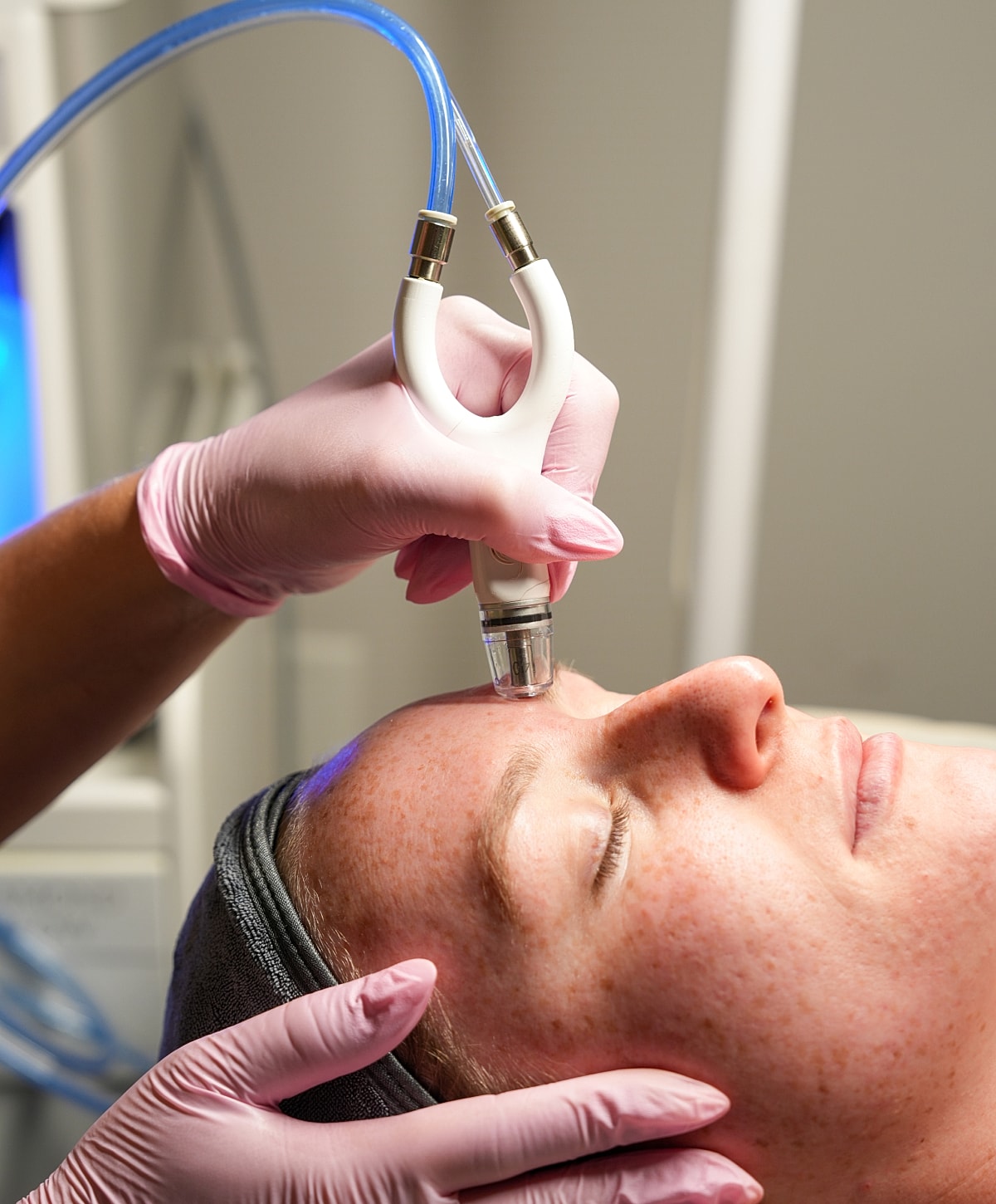 Facial treatment using microneedling device.