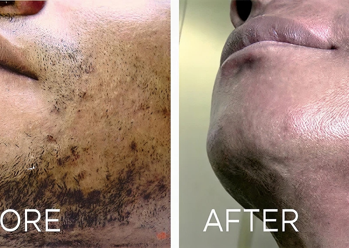Laser hair removal Before And After in Northborough, MA