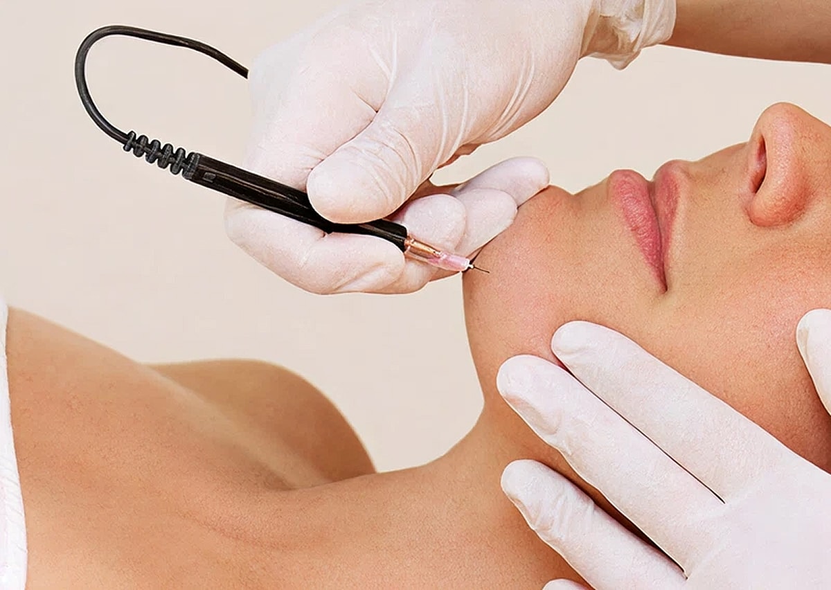 Northborough laser hair removal model having treatment performed.
