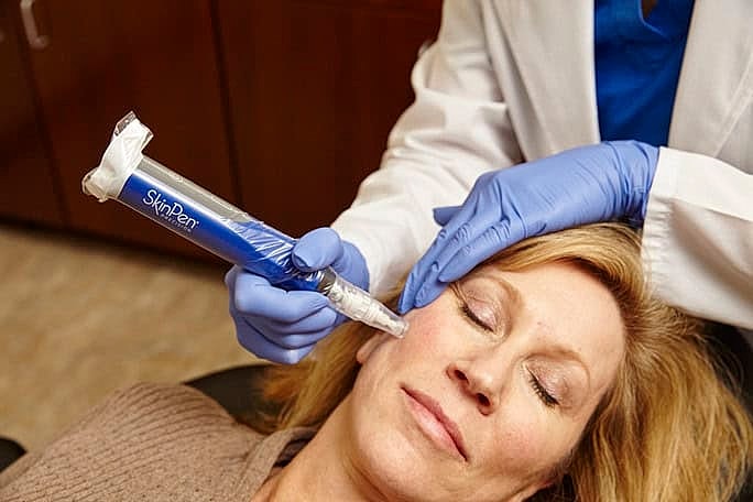 Northborough Microneedling model undergoing treatment