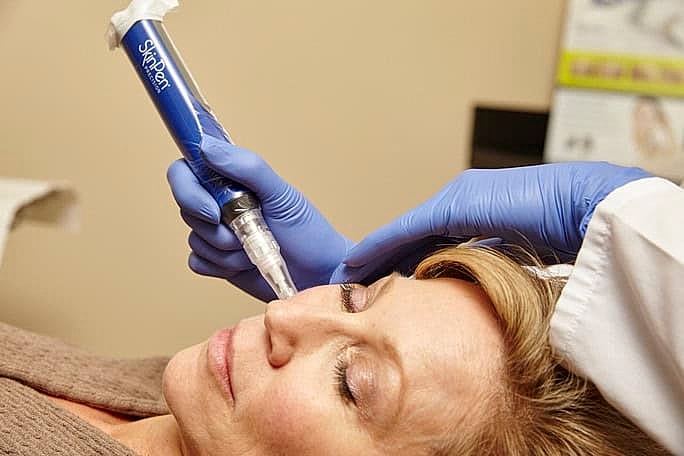 Northborough Microneedling model undergoing treatment