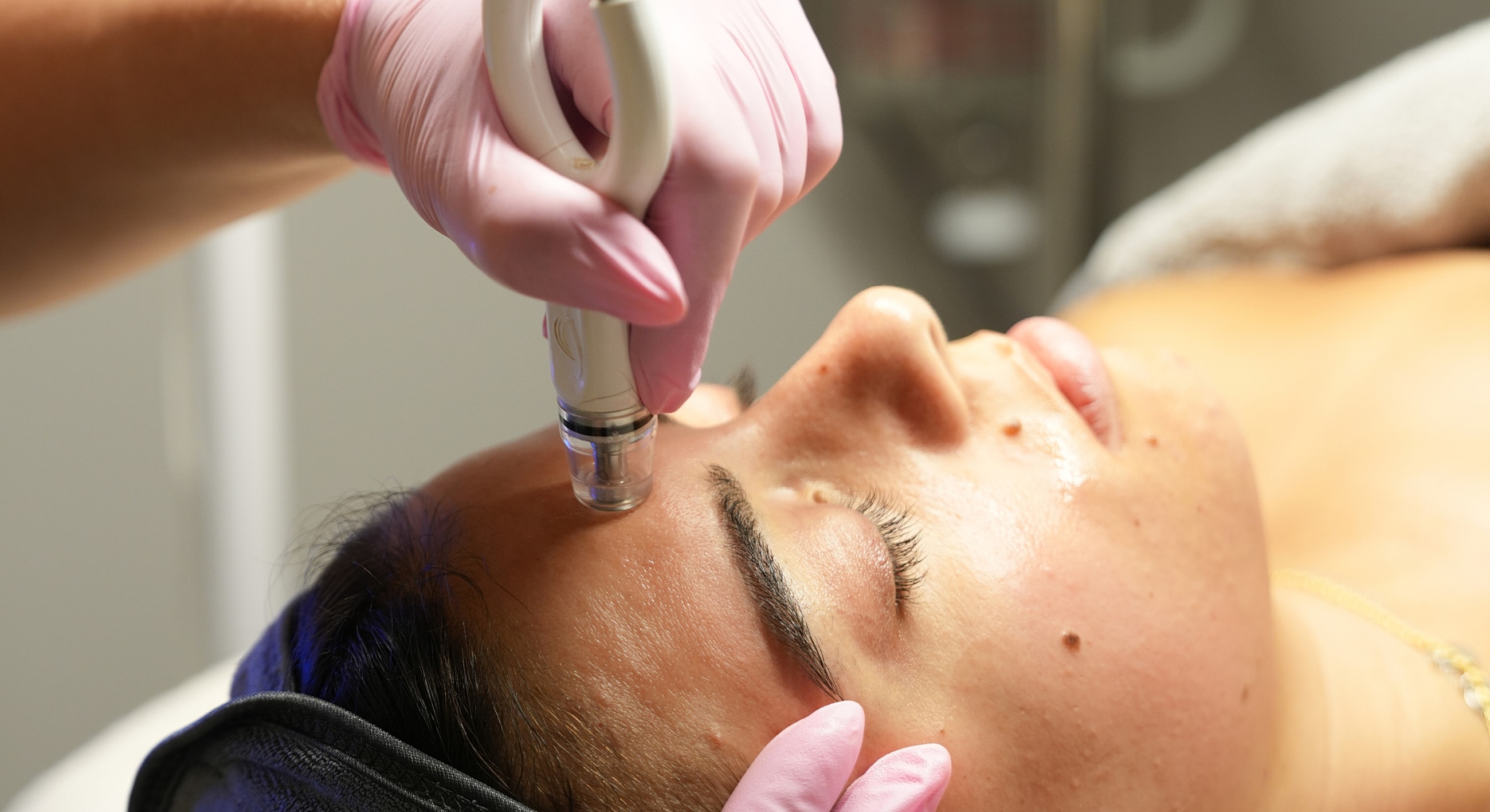 Microneedling treatment for facial rejuvenation.